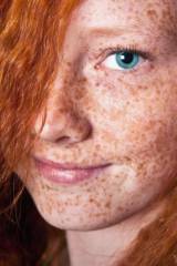 Freckles...